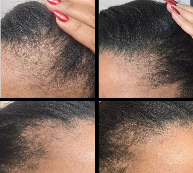 PRP hair restoration before and after results at Bonato MD Aesthetics in Medford, OR