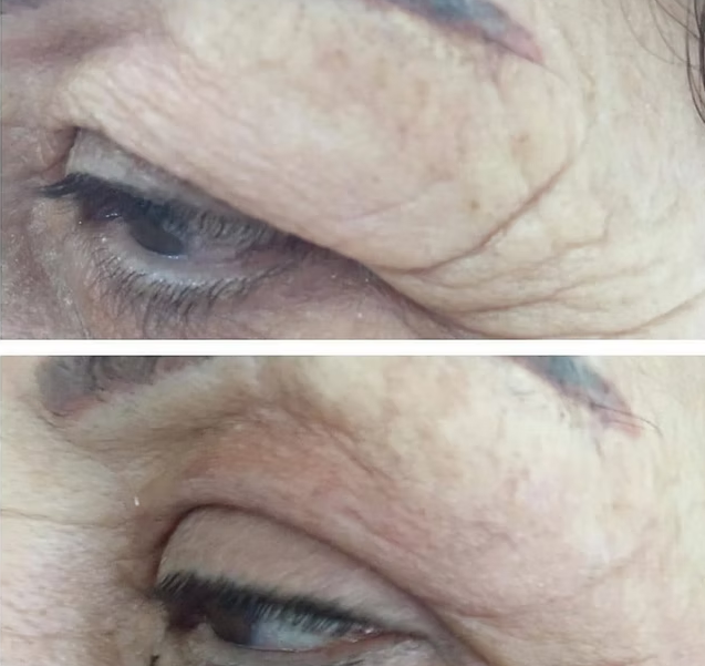 PLEXR Plus non-surgical eyelid lift before and after — Bonato MD Aesthetics