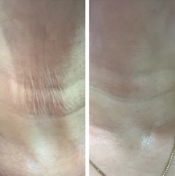 PLEXR Plus non-surgical neck lift before and after — Bonato MD Aesthetics