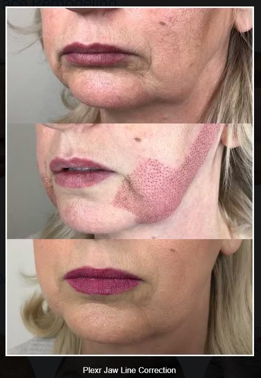 PLEXR Plus non-surgical jowl lift before and after — Bonato MD Aesthetics