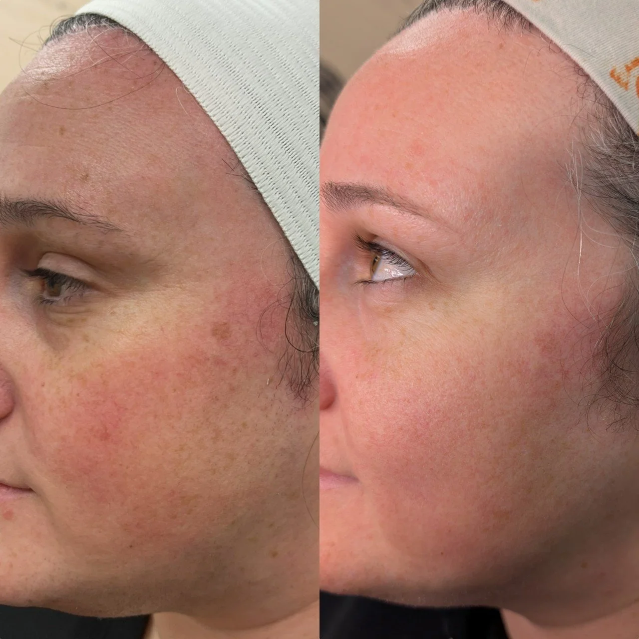 NOUVADerm laser skin rejuvenation before and after at Bonato MD Aesthetics in Medford, OR