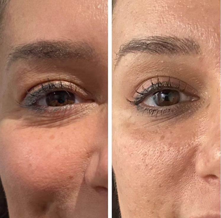 PLEXR Plus non-surgical eyelid lift before and after — Bonato MD Aesthetics