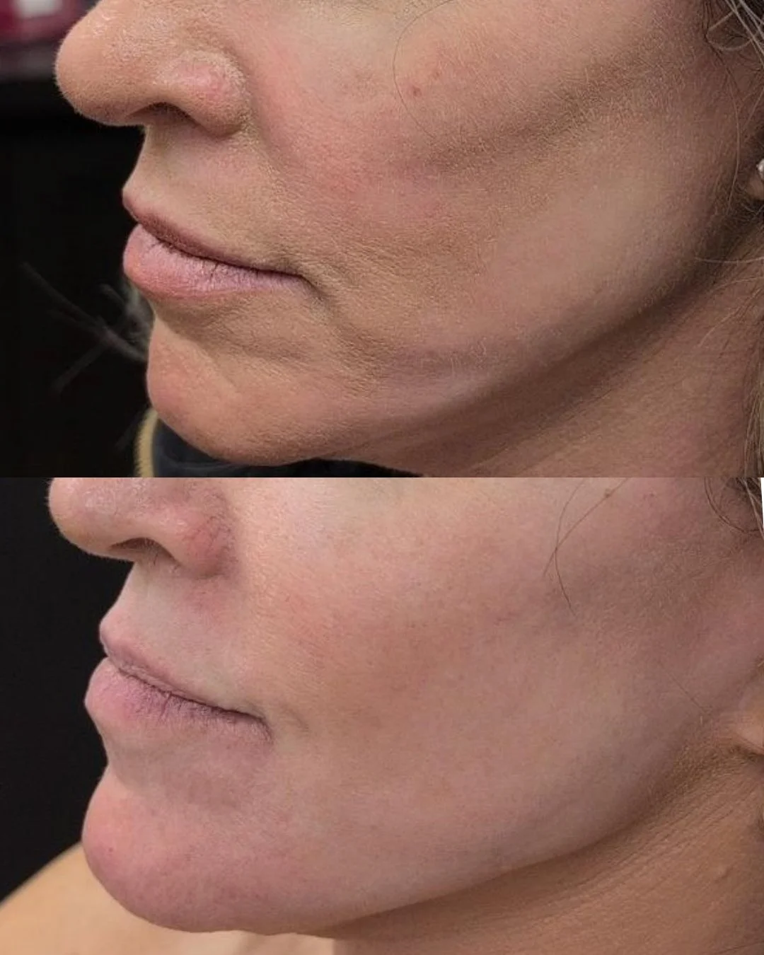 SCULPTRA
