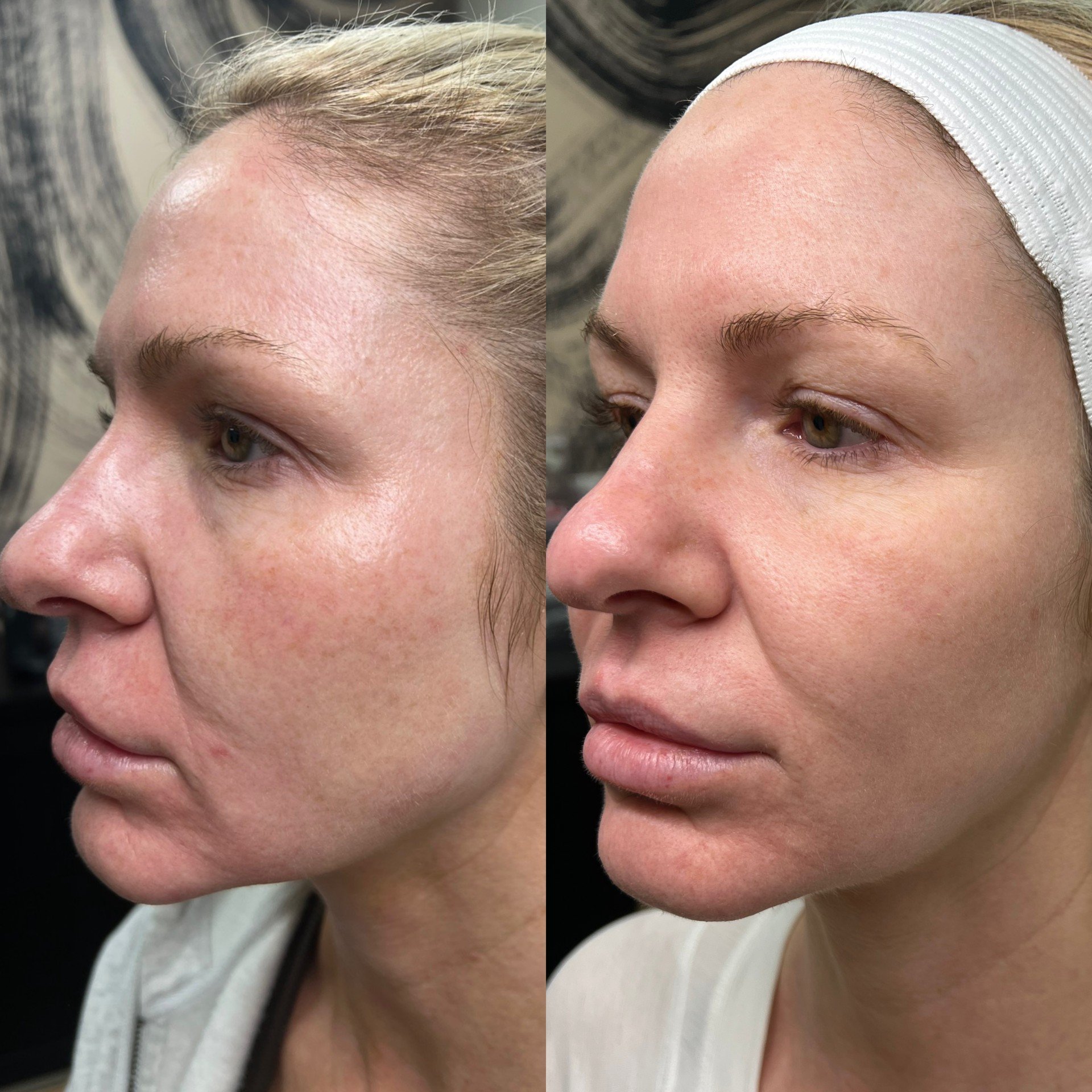 NOUVADerm laser skin rejuvenation before and after at Bonato MD Aesthetics in Medford, OR