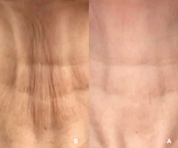 PLEXR Plus non-surgical neck lift before and after — Bonato MD Aesthetics