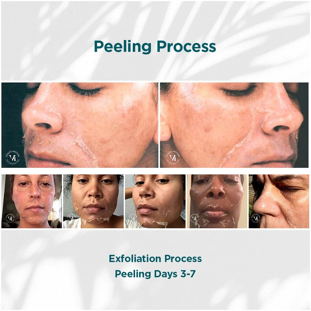 VI Peel chemical peel before and after at Bonato MD Aesthetics in Medford, OR