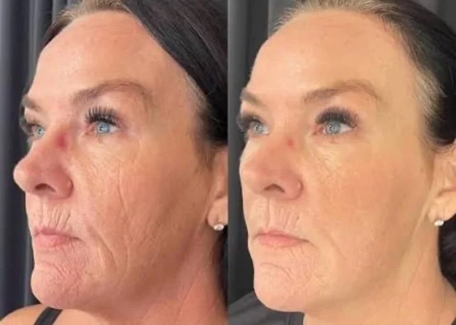 NOUVADerm laser skin rejuvenation before and after at Bonato MD Aesthetics in Medford, OR