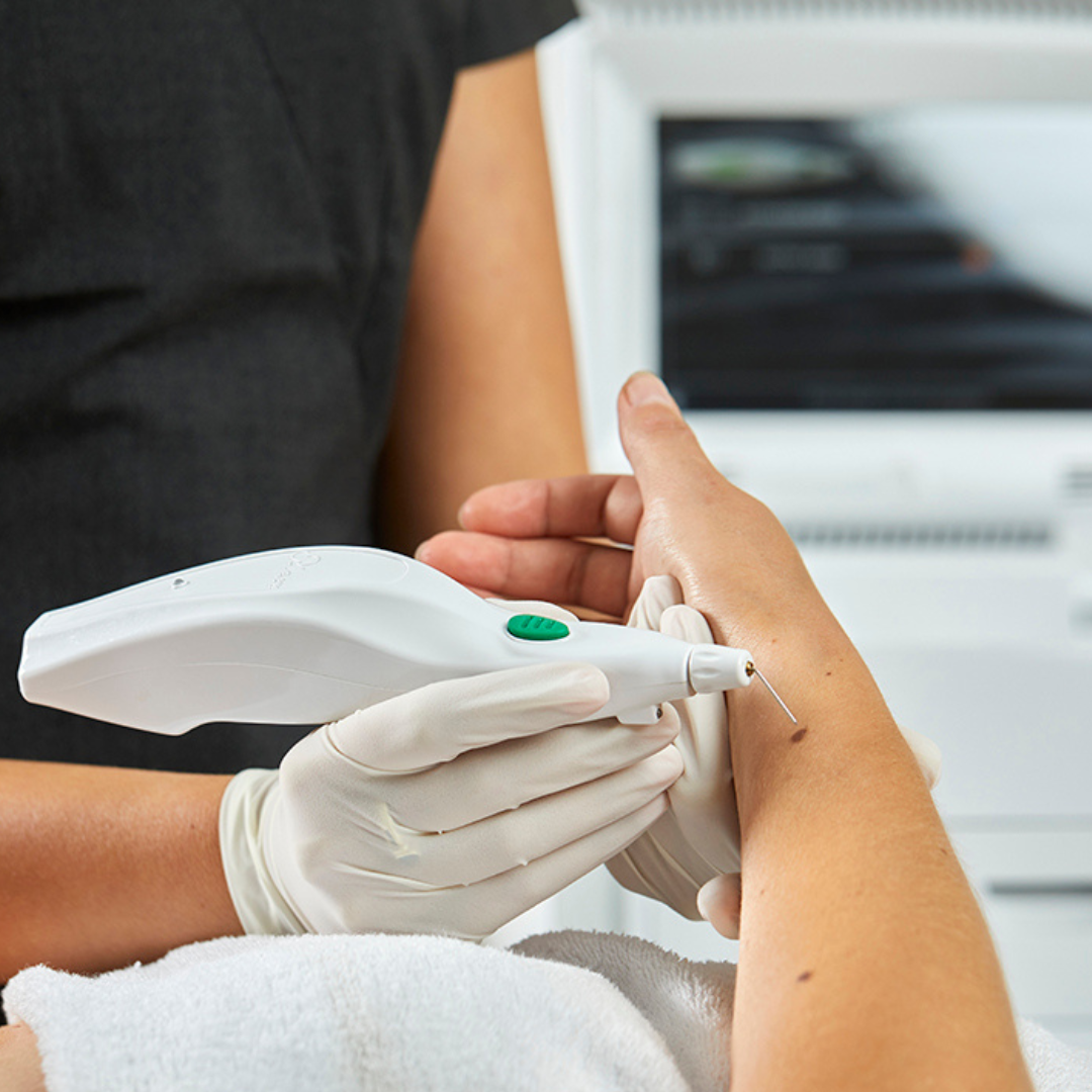 PLEXR Plus plasma device used for benign skin lesion removal in Medford, Oregon