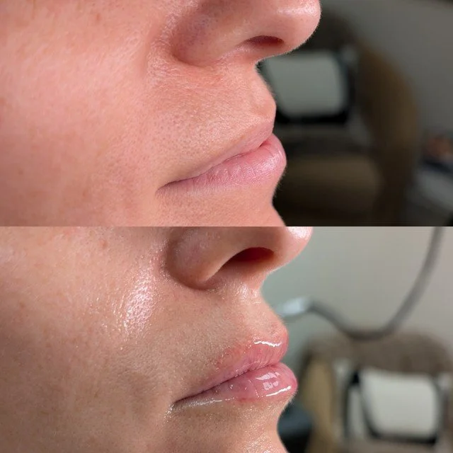 Lip filler before and after results at Bonato MD Aesthetics in Medford, OR