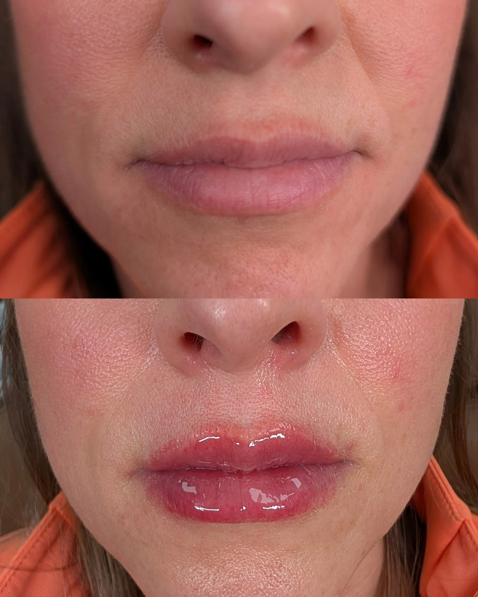 Lip filler before and after results at Bonato MD Aesthetics in Medford, OR