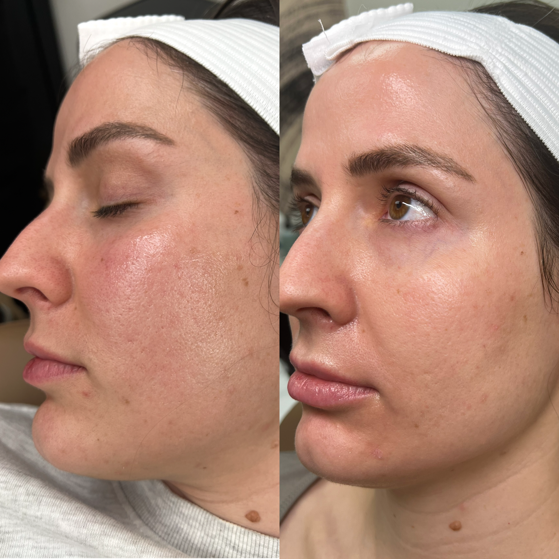 NOUVADerm laser skin rejuvenation before and after at Bonato MD Aesthetics in Medford, OR
