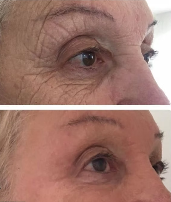 PLEXR Plus non-surgical eyelid lift before and after — Bonato MD Aesthetics