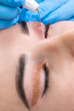 PLEXR Plus non surgical blepharoplasty Medford, Oregon, M