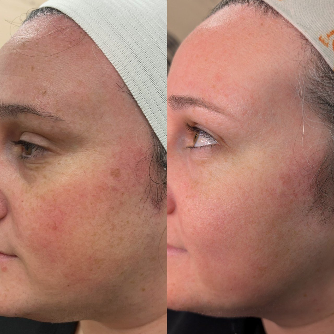 NOUVADerm laser skin rejuvenation before and after at Bonato MD Aesthetics in Medford, OR