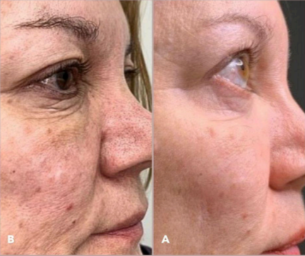 PLEXR Plus non-surgical eyelid lift before and after — Bonato MD Aesthetics