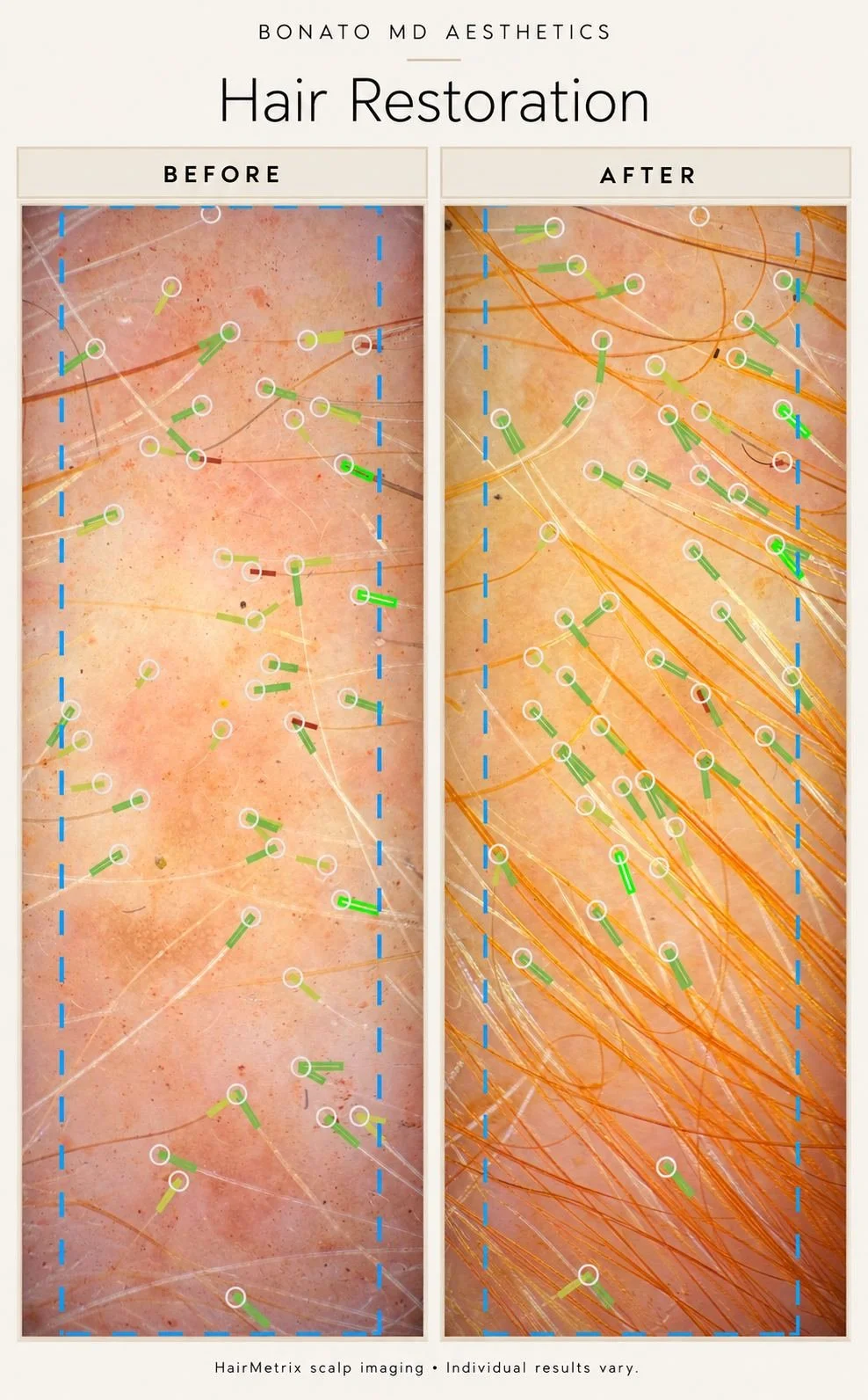 HairMetrix scalp images before and after hair restoration treatment