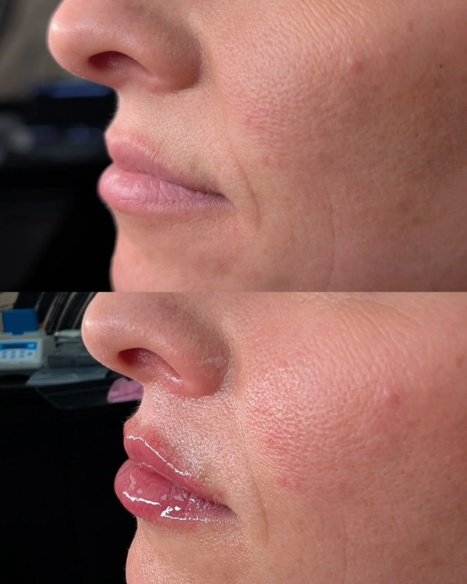 Lip filler before and after results at Bonato MD Aesthetics in Medford, OR