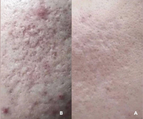 PLEXR Plus acne scar treatment before and after — Bonato MD Aesthetics