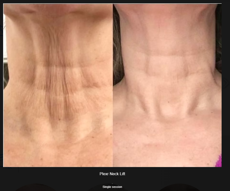 PLEXR Plus non-surgical neck lift before and after — Bonato MD Aesthetics
