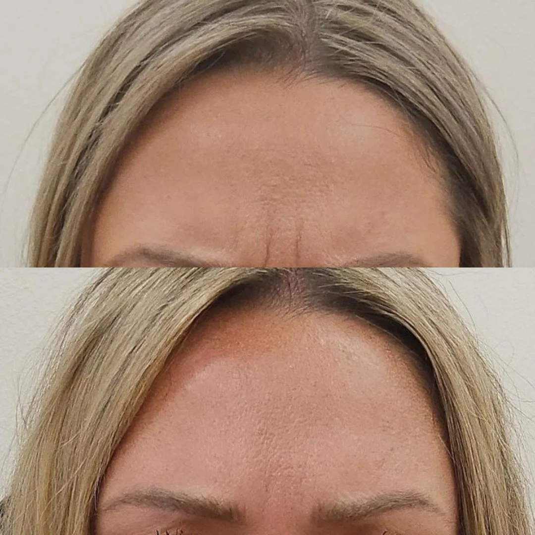 Dysport before and after results at Bonato MD Aesthetics in Medford, OR