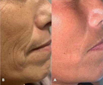 PLEXR Plus non-surgical wrinkle correction before and after — Bonato MD Aesthetics