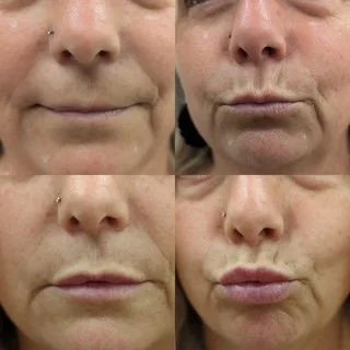 Lip filler before and after results at Bonato MD Aesthetics in Medford, OR
