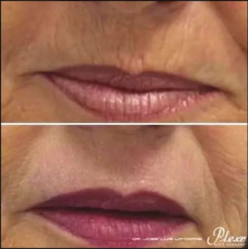 PLEXR Plus non-surgical peri-oral line correction before and after — Bonato MD Aesthetics