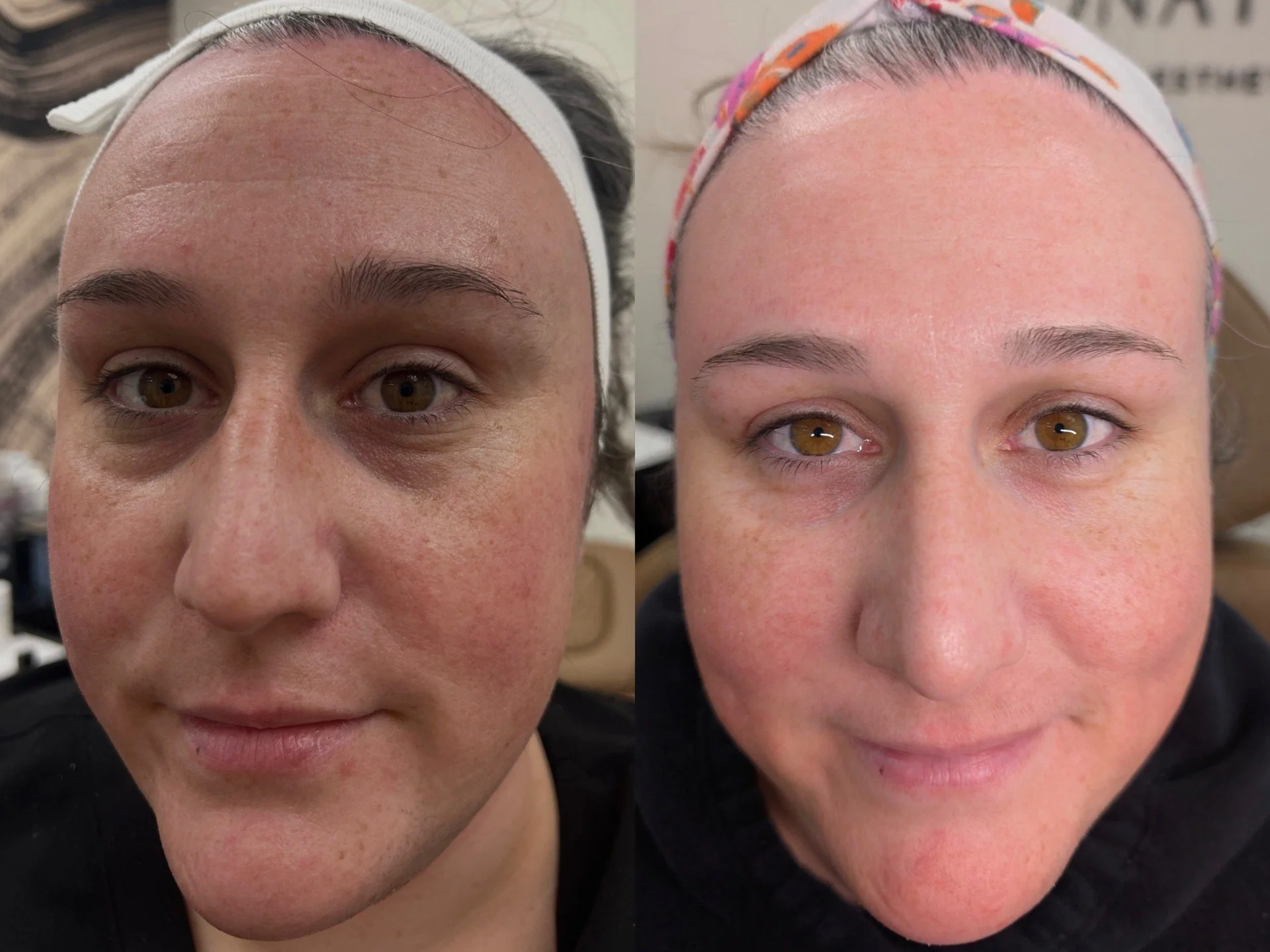 NOUVADerm laser skin rejuvenation before and after at Bonato MD Aesthetics in Medford, OR