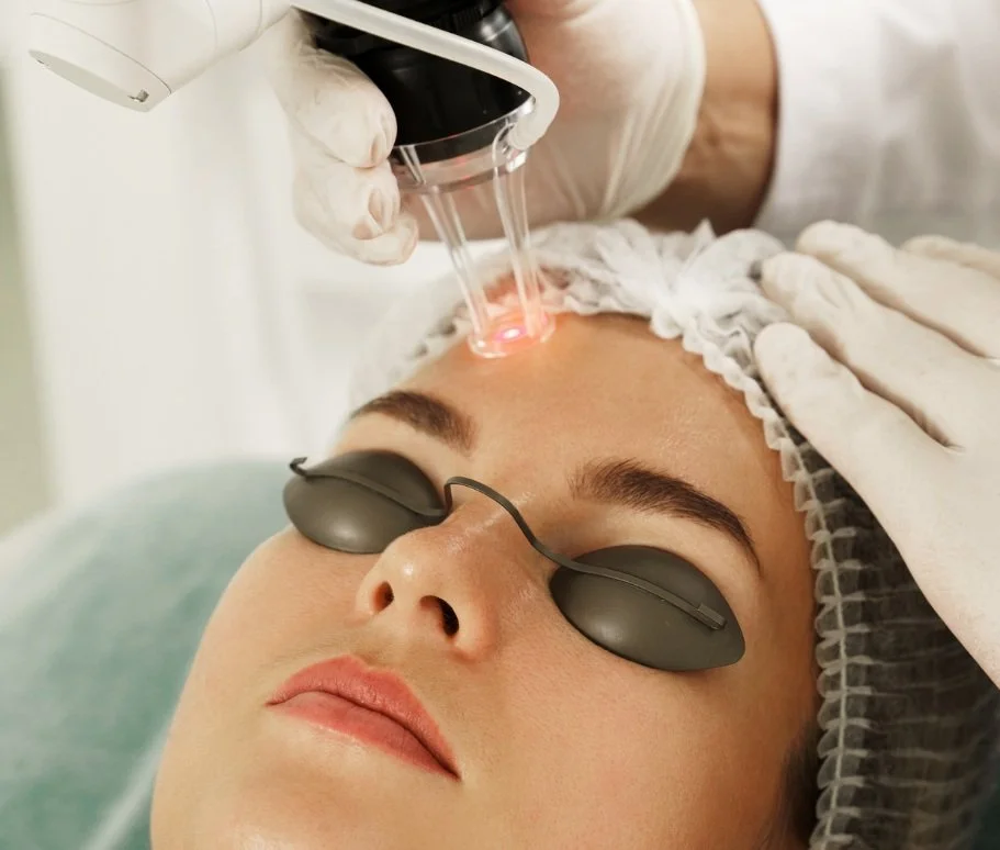 A woman receiving laser skin treatment on her forehead in a medical setting