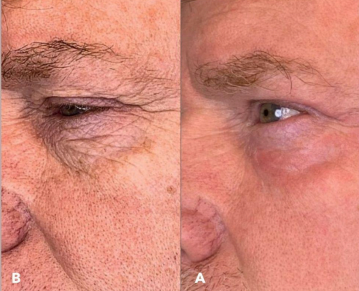 PLEXR Plus non-surgical eyelid lift before and after — Bonato MD Aesthetics