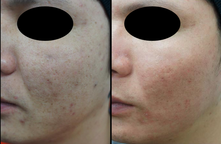 NOUVADerm laser skin rejuvenation before and after at Bonato MD Aesthetics in Medford, OR