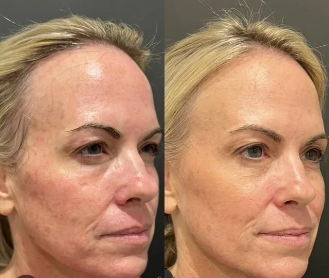 NOUVADerm laser skin rejuvenation before and after at Bonato MD Aesthetics in Medford, OR