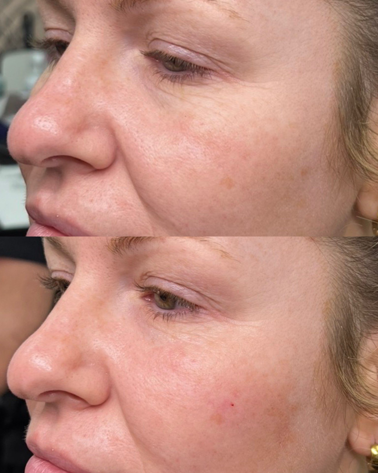 Cellenis Derma PRP gel filler before and after at Bonato MD Aesthetics in Medford, OR