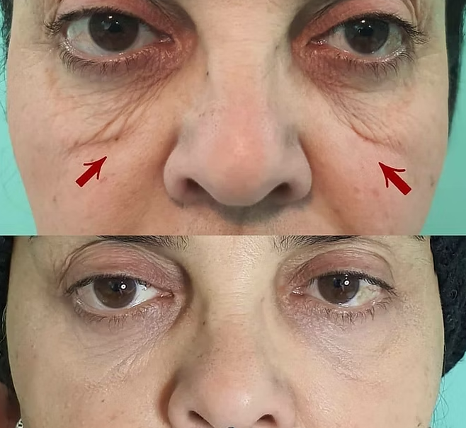 PLEXR Plus non-surgical eye lift before and after — Bonato MD Aesthetics