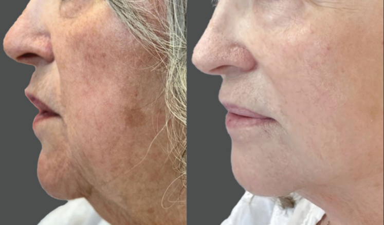 NOUVADerm laser skin rejuvenation before and after at Bonato MD Aesthetics in Medford, OR
