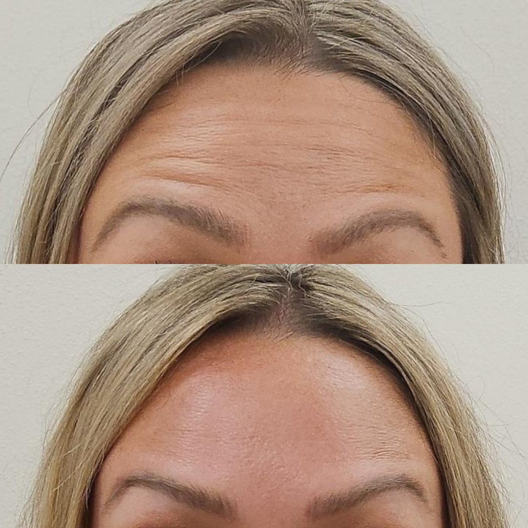 Dysport before and after results at Bonato MD Aesthetics in Medford, OR