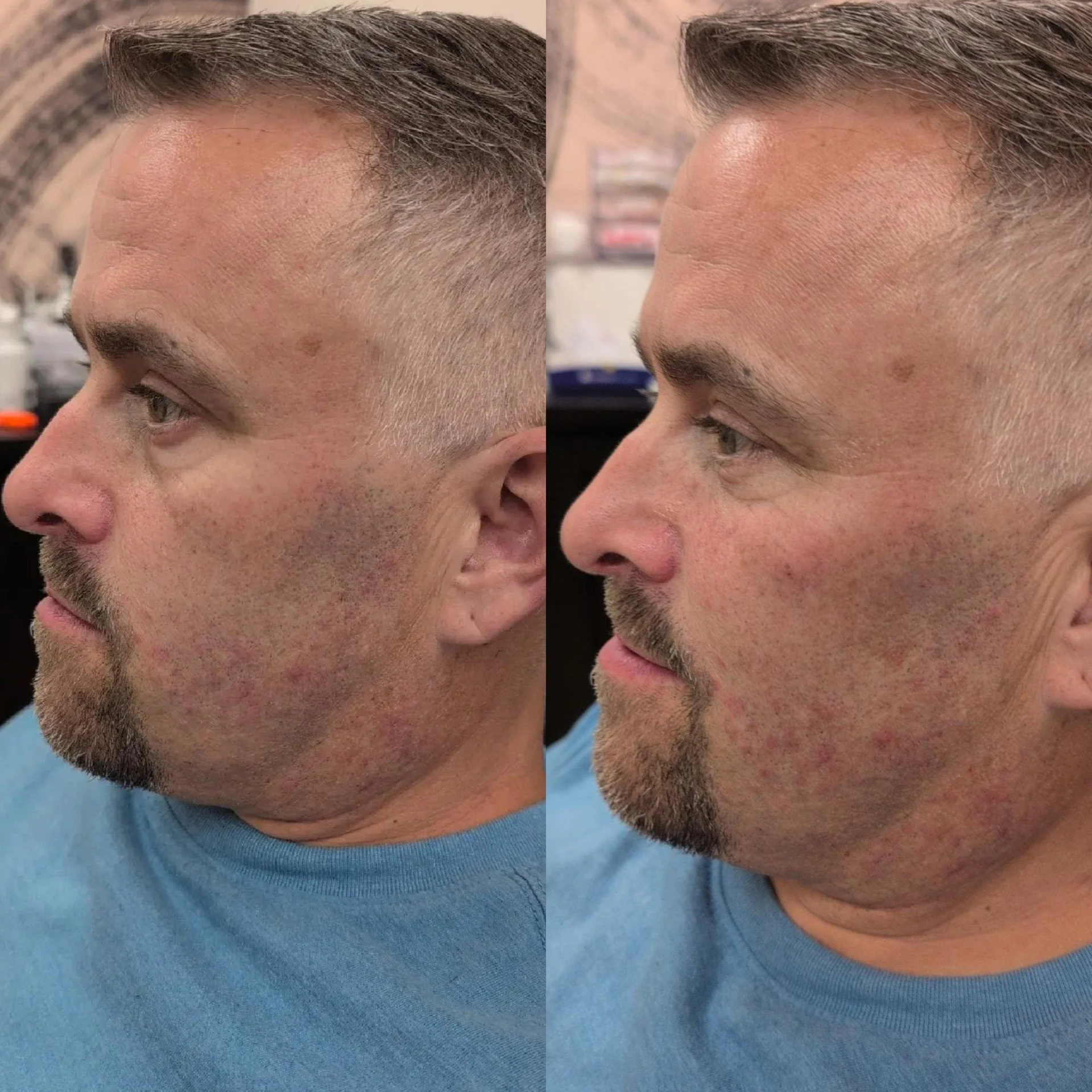 Cellenis Derma PRP gel filler before and after at Bonato MD Aesthetics in Medford, OR
