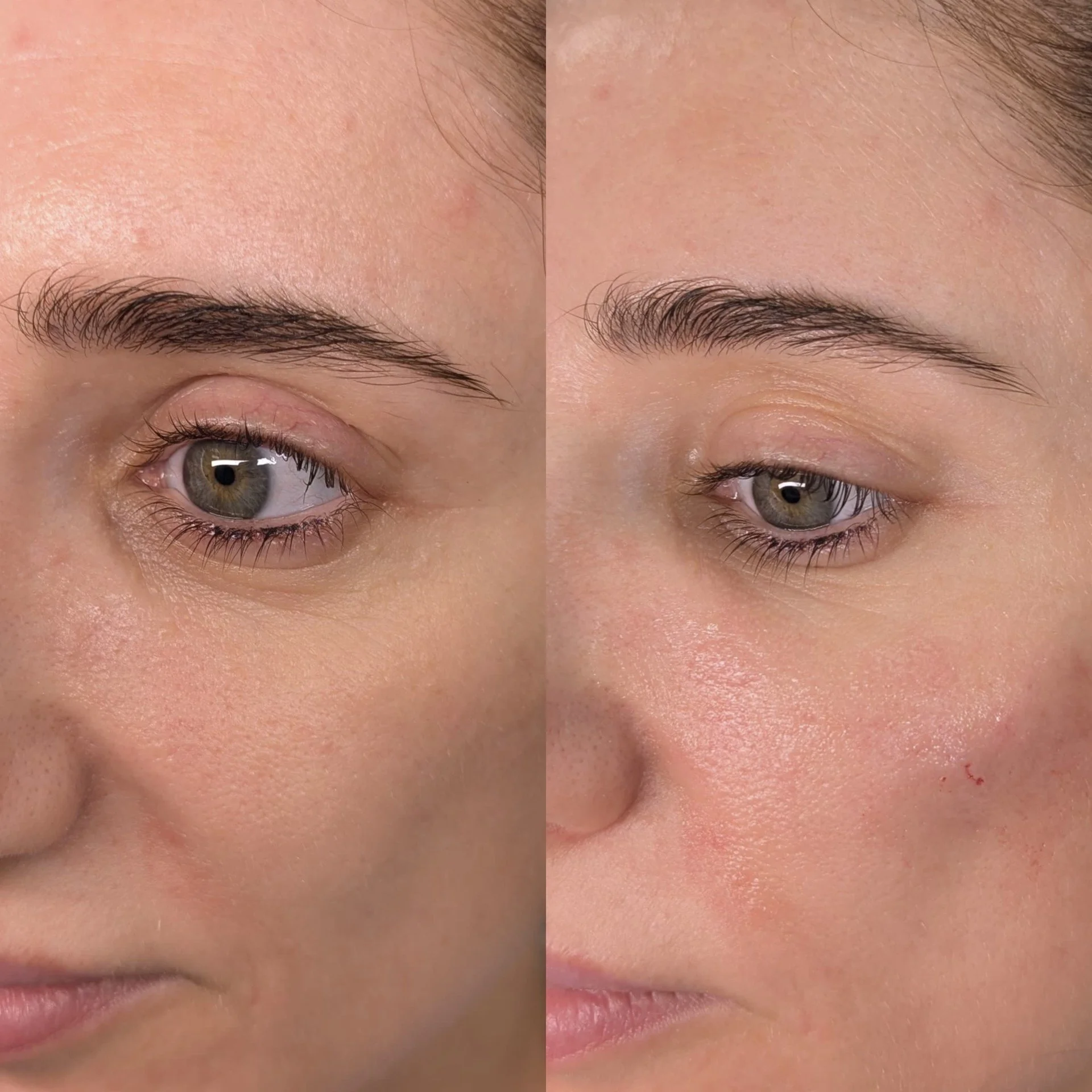 Cellenis Derma PRP gel filler before and after at Bonato MD Aesthetics in Medford, OR