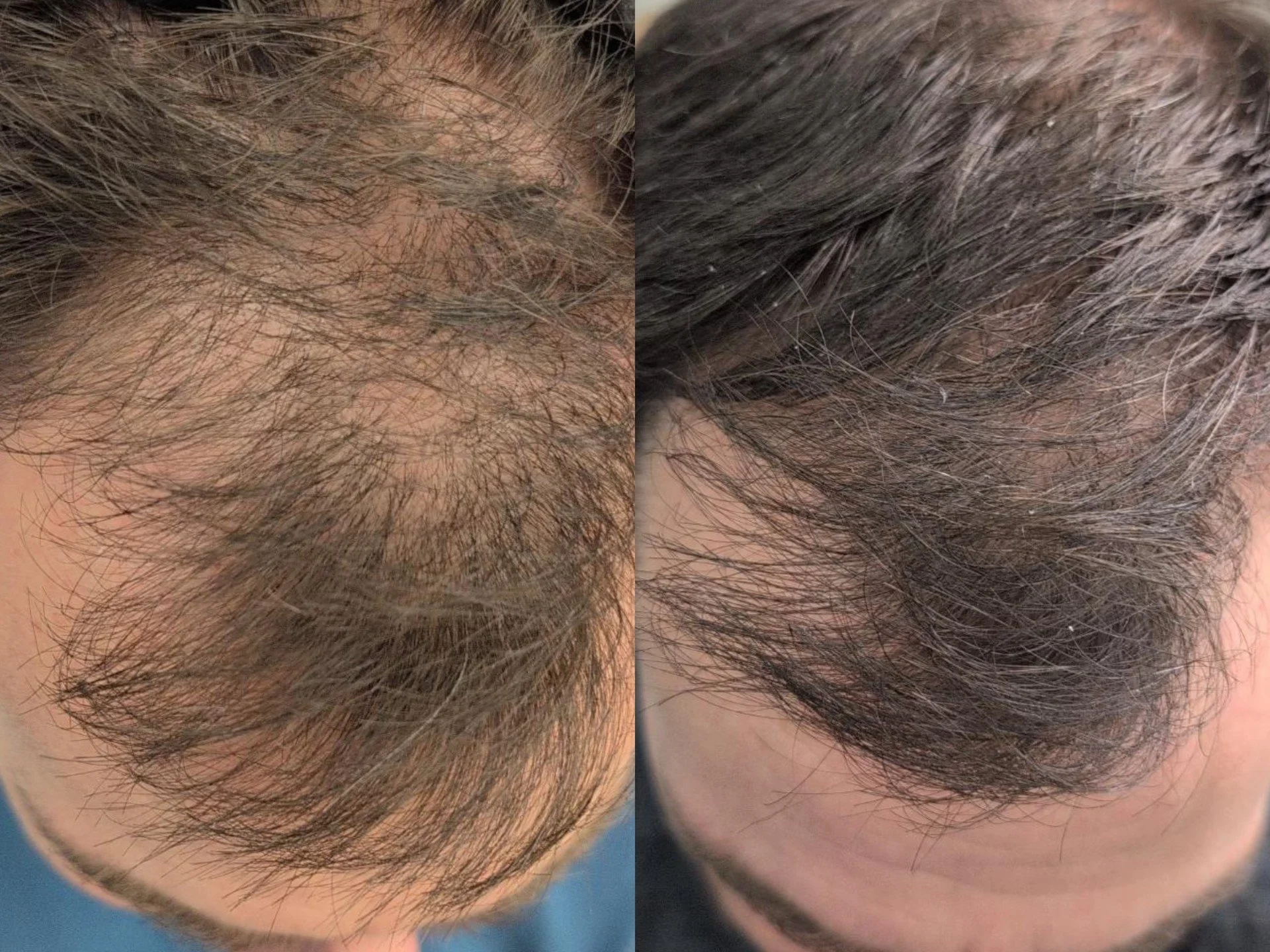 PRP hair restoration before and after results at Bonato MD Aesthetics in Medford, OR