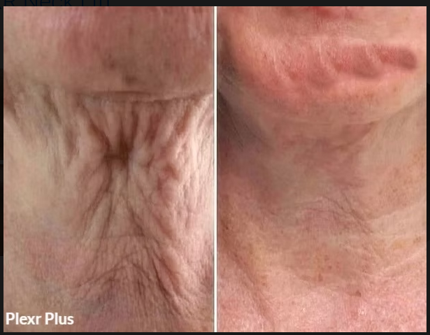 PLEXR Plus non-surgical neck lift before and after — Bonato MD Aesthetics