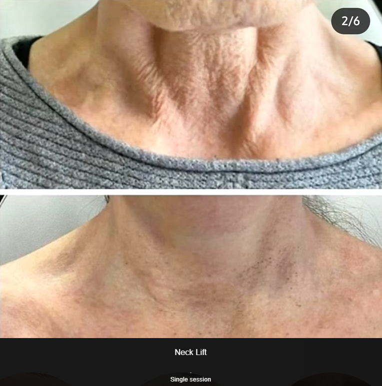 PLEXR Plus non-surgical neck lift before and after — Bonato MD Aesthetics
