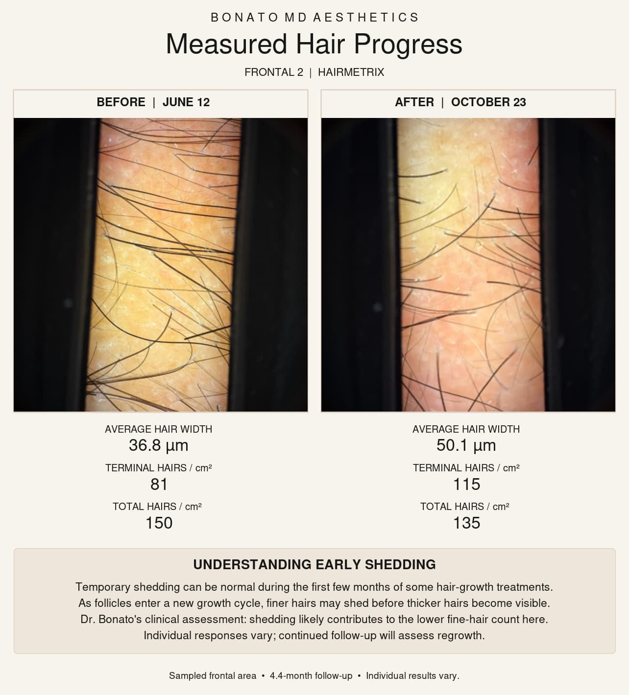 HairMetrix frontal scalp images showing temporary shedding during hair restoration