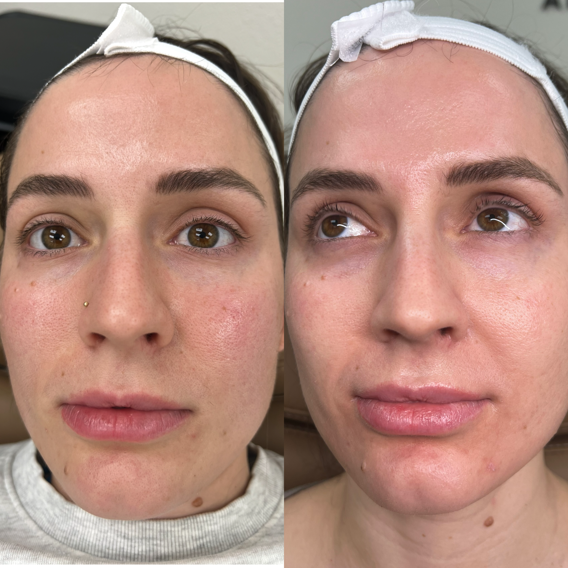 NOUVADerm laser skin rejuvenation before and after at Bonato MD Aesthetics in Medford, OR
