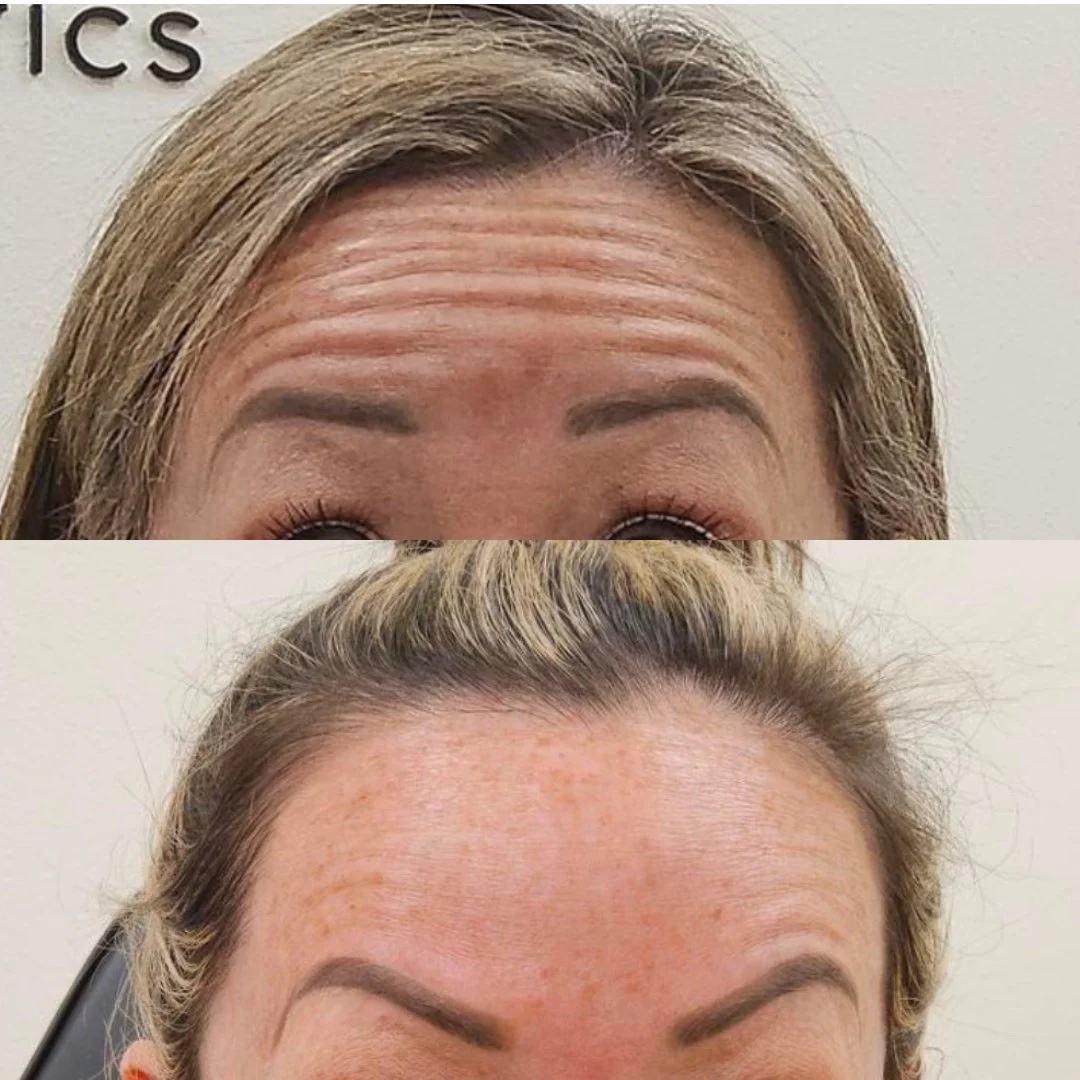 Dysport before and after results at Bonato MD Aesthetics in Medford, OR