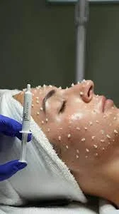 Close-up of a woman's face with dots indicating acupuncture points, while a medical professional inserts a thin needle into her face during a cosmetic treatment