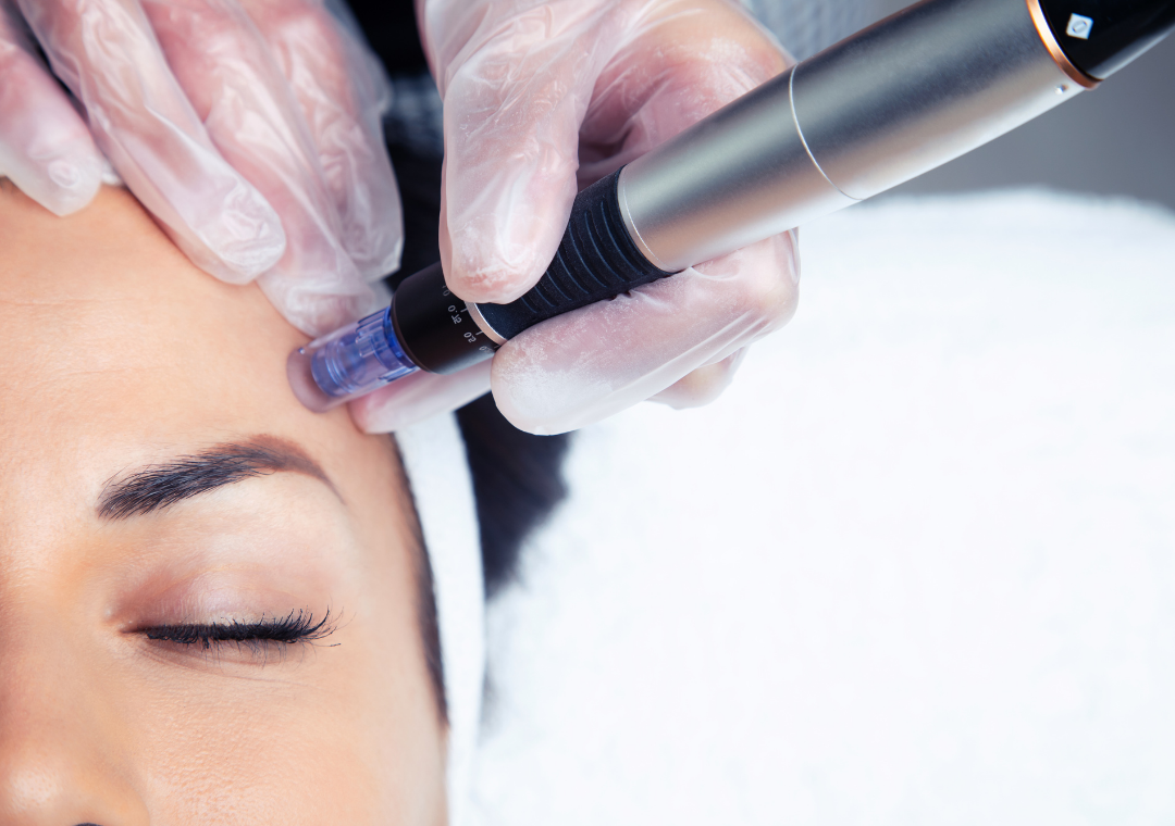 Medspa in Manchester, MI, 48158 RF Microneedling Near Me