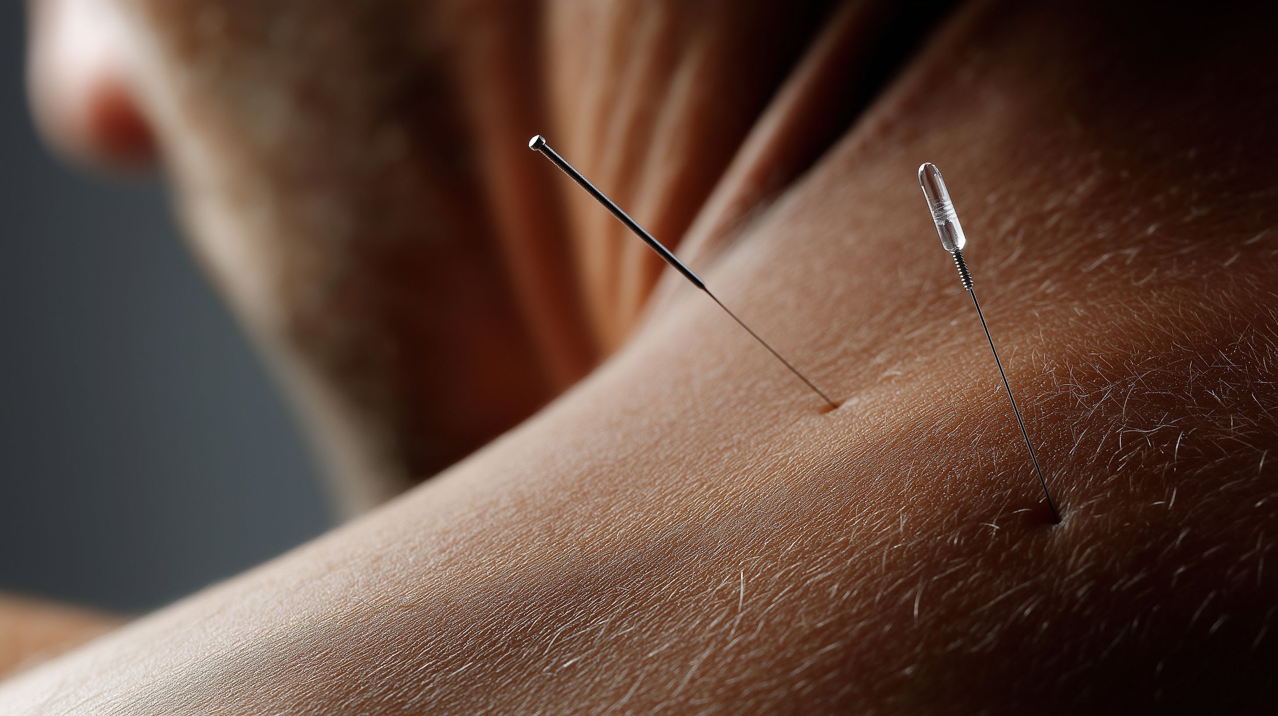 Close-up of a person's skin with two acupuncture needles inserted.