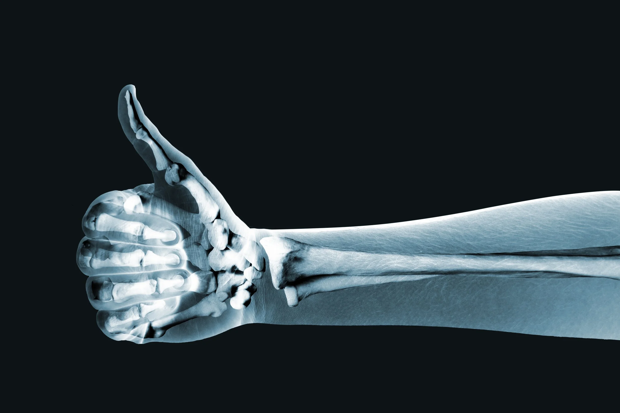 X-ray image of a human arm and hand showing bones with a thumbs-up gesture.