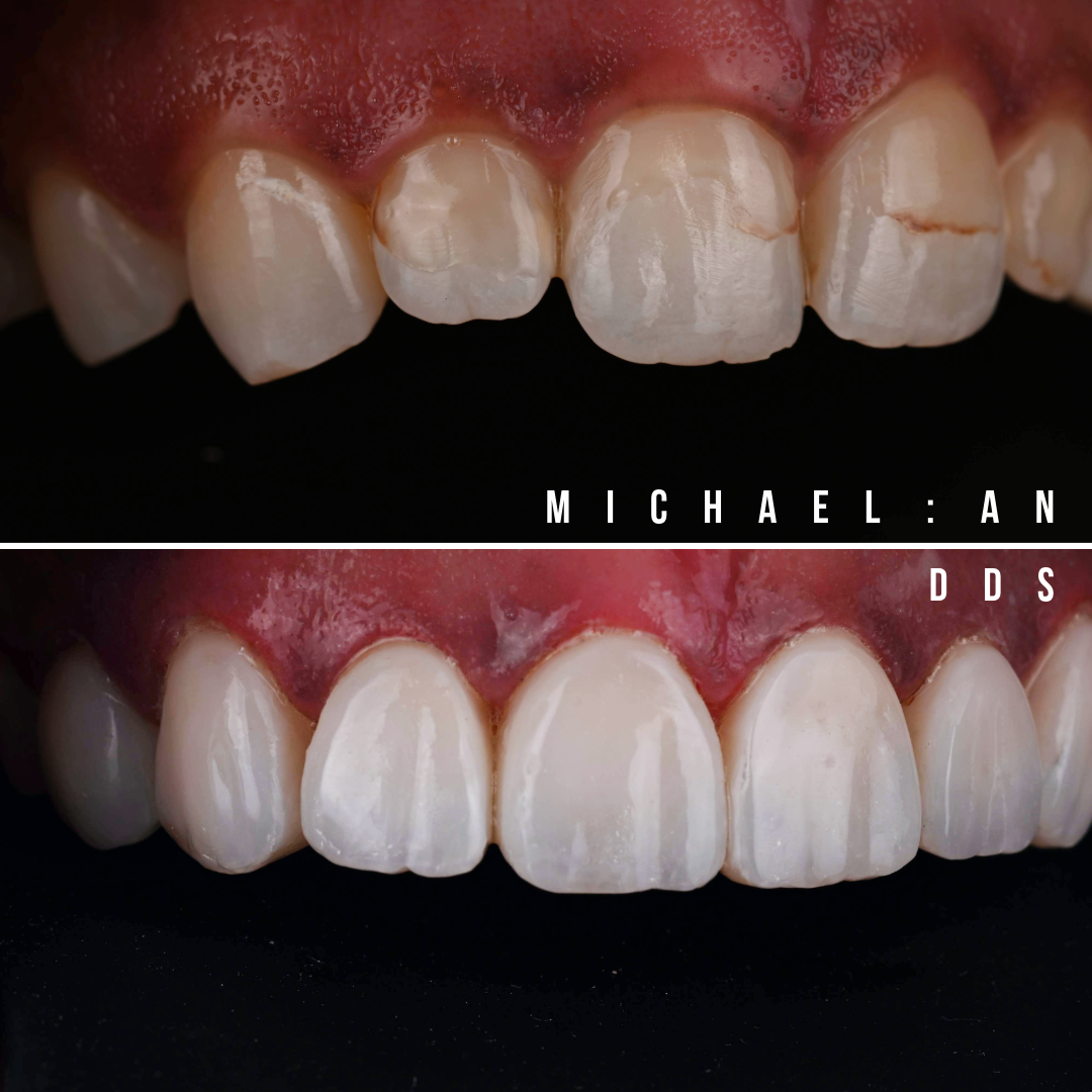 2. 032424 B&A_UPPER TEETH 2.png