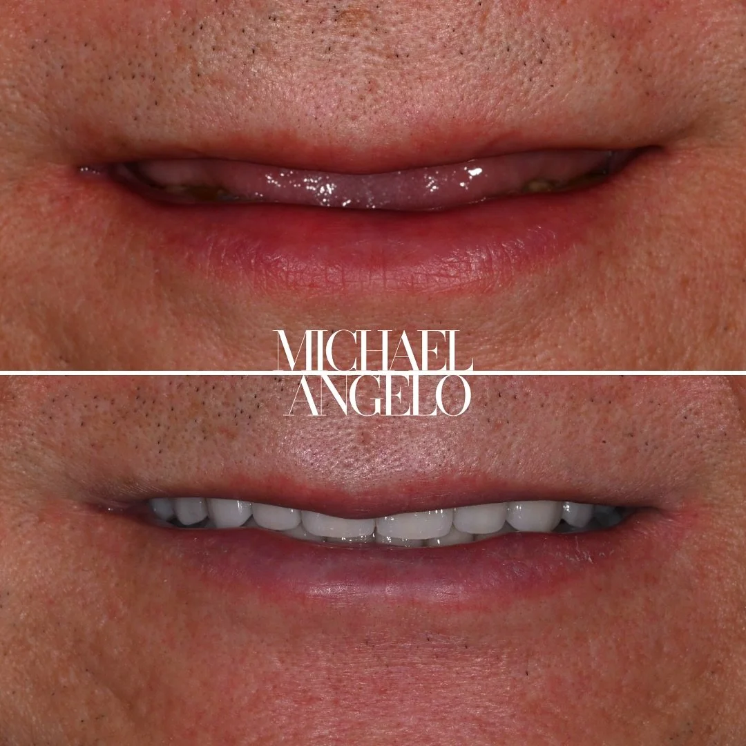 • ๐ ๐๐ฅ๐จ๐ฌ๐๐ซ ๐ฅ๐จ๐จ๐ค ๐๐ญ ๐ญ๐ก๐ข๐ฌ ๐๐๐๐ฎ๐ญ๐ข๐๐ฎ๐ฅ ๐ญ๐ซ๐๐ง๐ฌ๐๐จ๐ซ๐ฆ๐๐ญ๐ข๐จ๐ง
This gentleman came to me with years of severe tooth wear and erosion — his smile showed almost no visible teeth. Through a full mouth rehabilitation